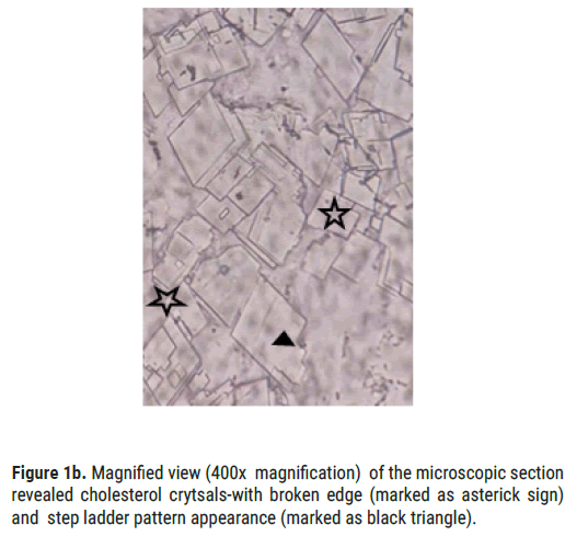 arthritis-microscopic