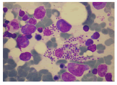 multiple-sclerosis-amastigotes