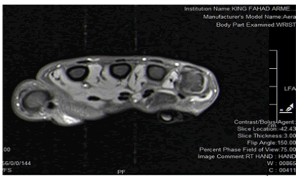 surgery-current-metacarpal