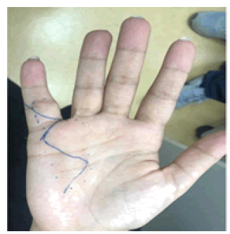 surgery-current-ulnar