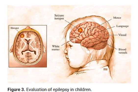 JNN-epilepsy