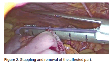 Reconstructive-Anaplastology-Stappling