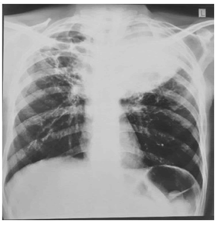 occrs-9-2-Carcinoma-g002