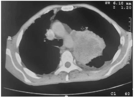 occrs-9-2-Carcinoma-g003