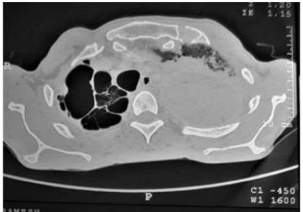 occrs-9-2-Carcinoma-g004