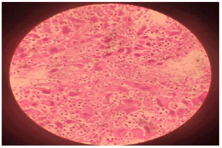 occrs-9-2-Carcinoma-g005