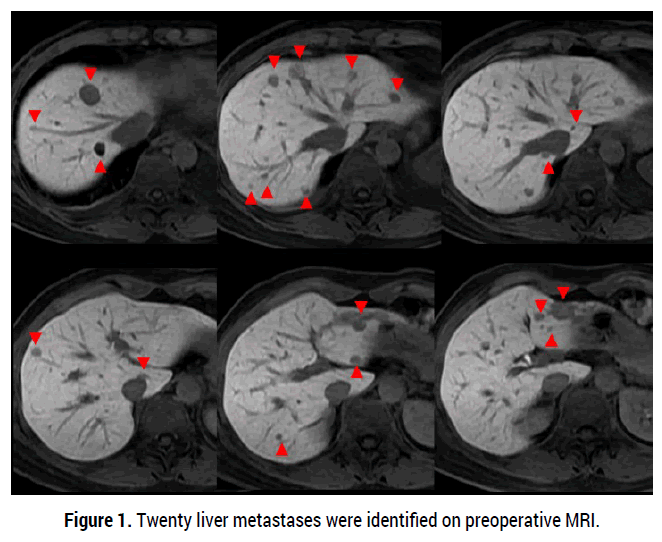 oncology-cancer-case-reports-liver-metastases