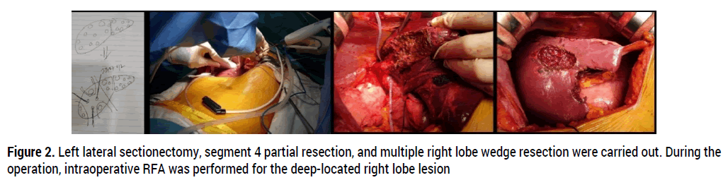 oncology-cancer-case-reports-liver-metastases