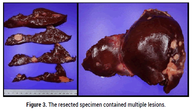 oncology-cancer-case-reports-liver-metastases