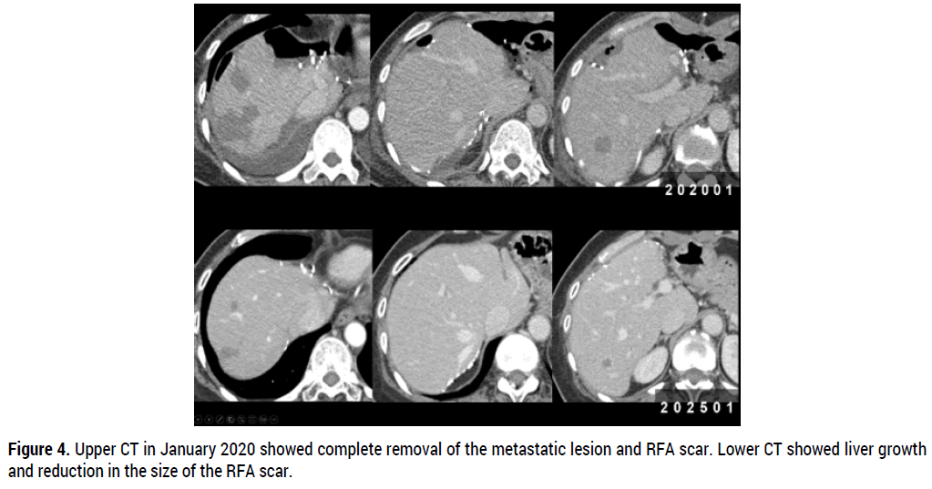 oncology-cancer-case-reports-liver-metastases