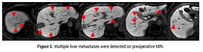 oncology-cancer-case-reports-liver-metastases