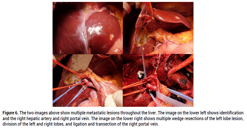 oncology-cancer-case-reports-liver-metastases