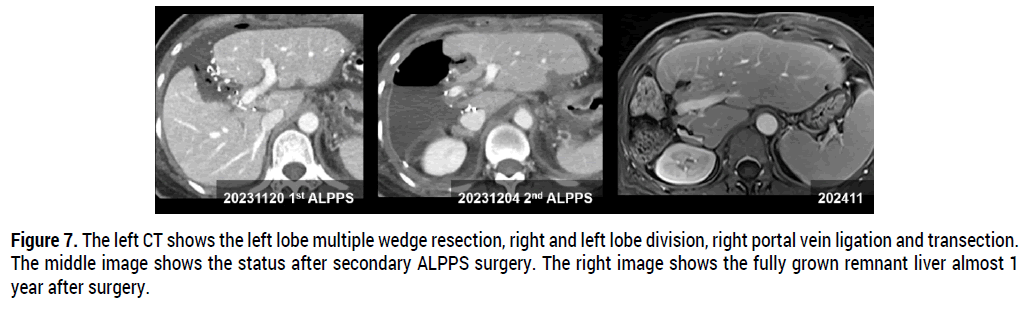 oncology-cancer-case-reports-liver-metastases