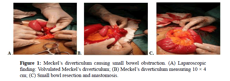 internalmedicine-
diverticulum