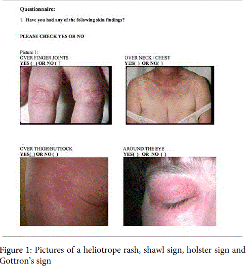 arthritis-Pictures-heliotrope-rash