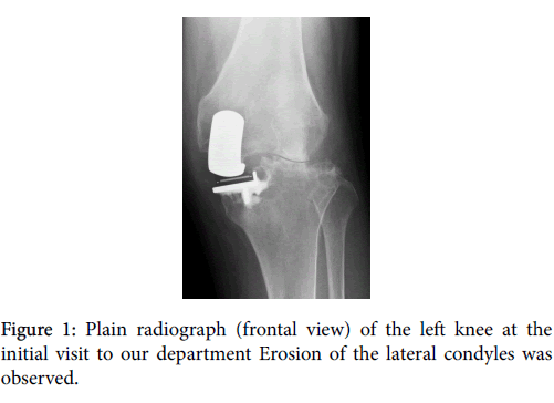 arthritis-Plain-radiograph