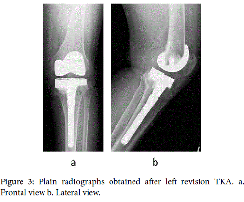 arthritis-Plain-radiographs
