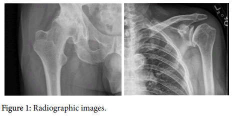 arthritis-Radiographic