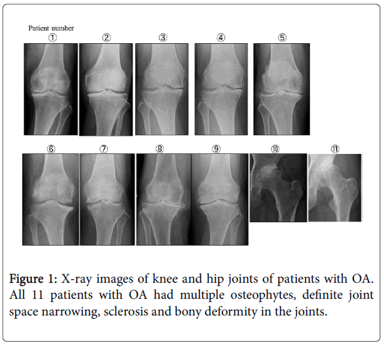 arthritis-X-ray-images