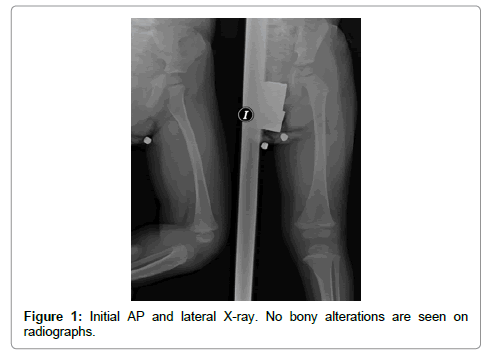 arthritis-bony-alterations