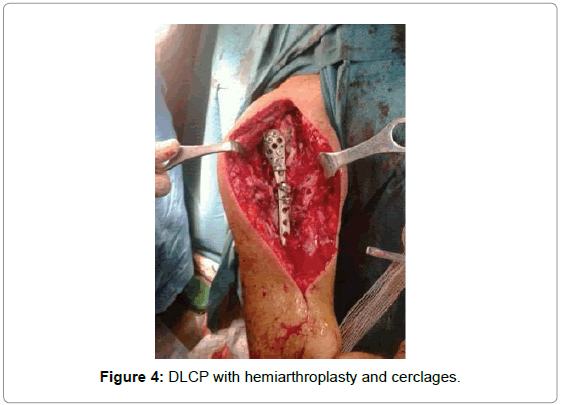 arthritis-hemiarthroplasty-cerclages