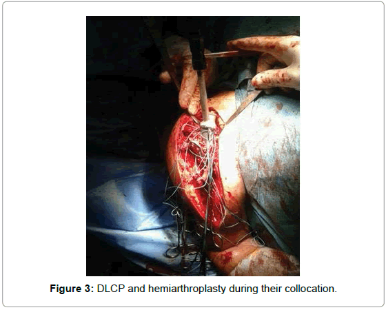 arthritis-hemiarthroplasty-during