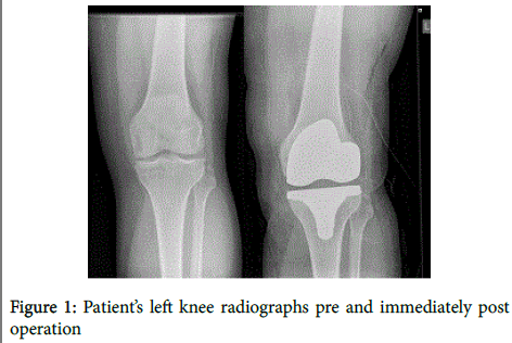 arthritis-left-knee