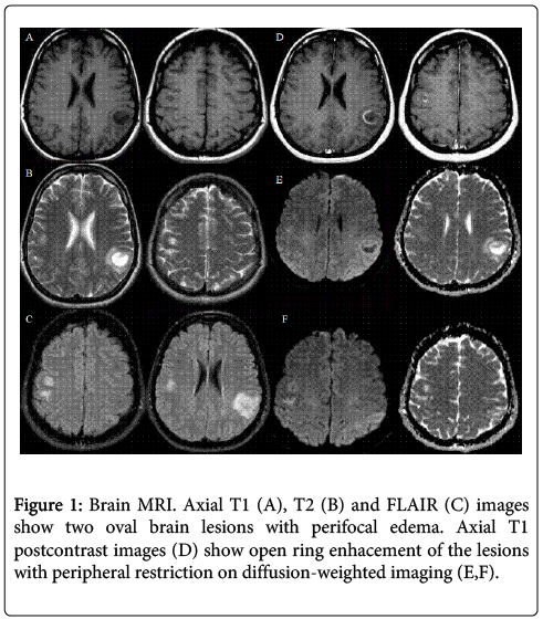 ms mri brain scan results