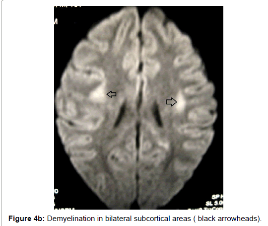 multiple-sclerosis-bilateral-subcortical