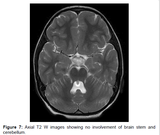 multiple-sclerosis-brain-stem