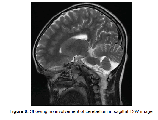 multiple-sclerosis-cerebellum-sagittal