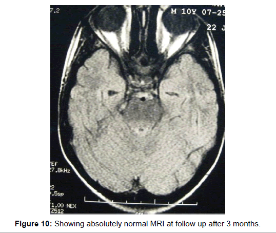 multiple-sclerosis-normal-MRI