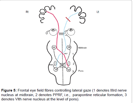 multiple-sclerosis-parapontine-reticular