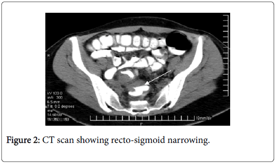oncology-cancer-case-reports-CT-scan
