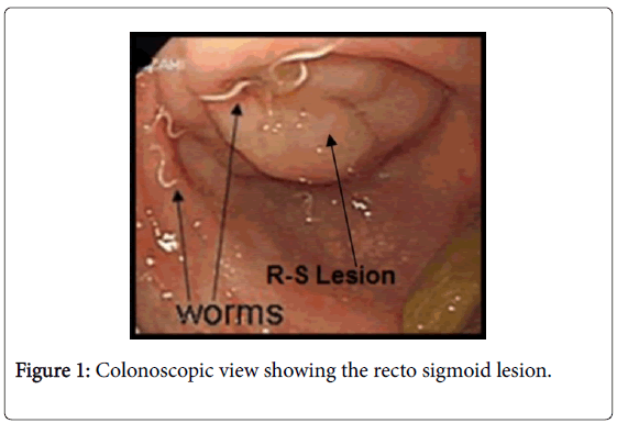 oncology-cancer-case-reports-Colonoscopic-view