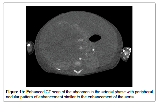 oncology-cancer-case-reports-Enhanced-CT-scan-abdomen