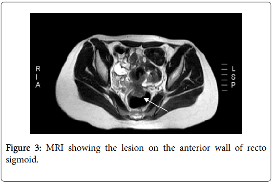 oncology-cancer-case-reports-anterior-wall