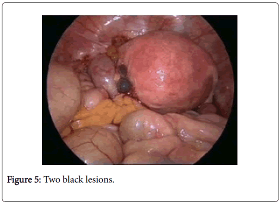 oncology-cancer-case-reports-black-lesions