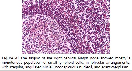 oncology-cancer-case-reports-cervical-lymph-node