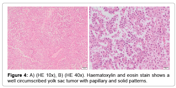 oncology-cancer-case-reports-eosin-stain