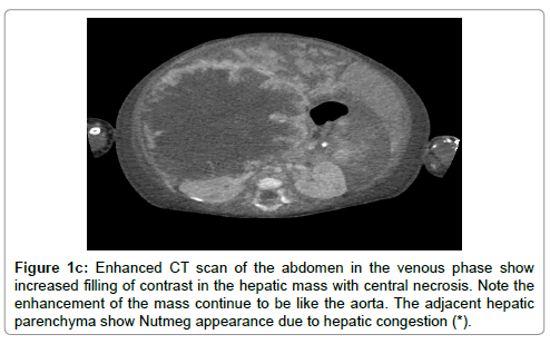 oncology-cancer-case-reports-hepatic-mass-central-necrosis