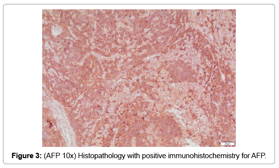 oncology-cancer-case-reports-positive-immunohistochemistry